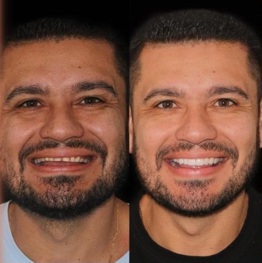 Antes e depois de tratamento estético