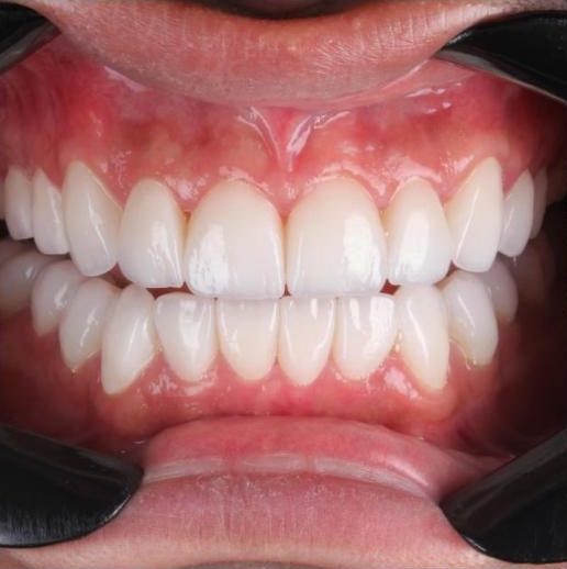 Sorriso com facetas finalizadas